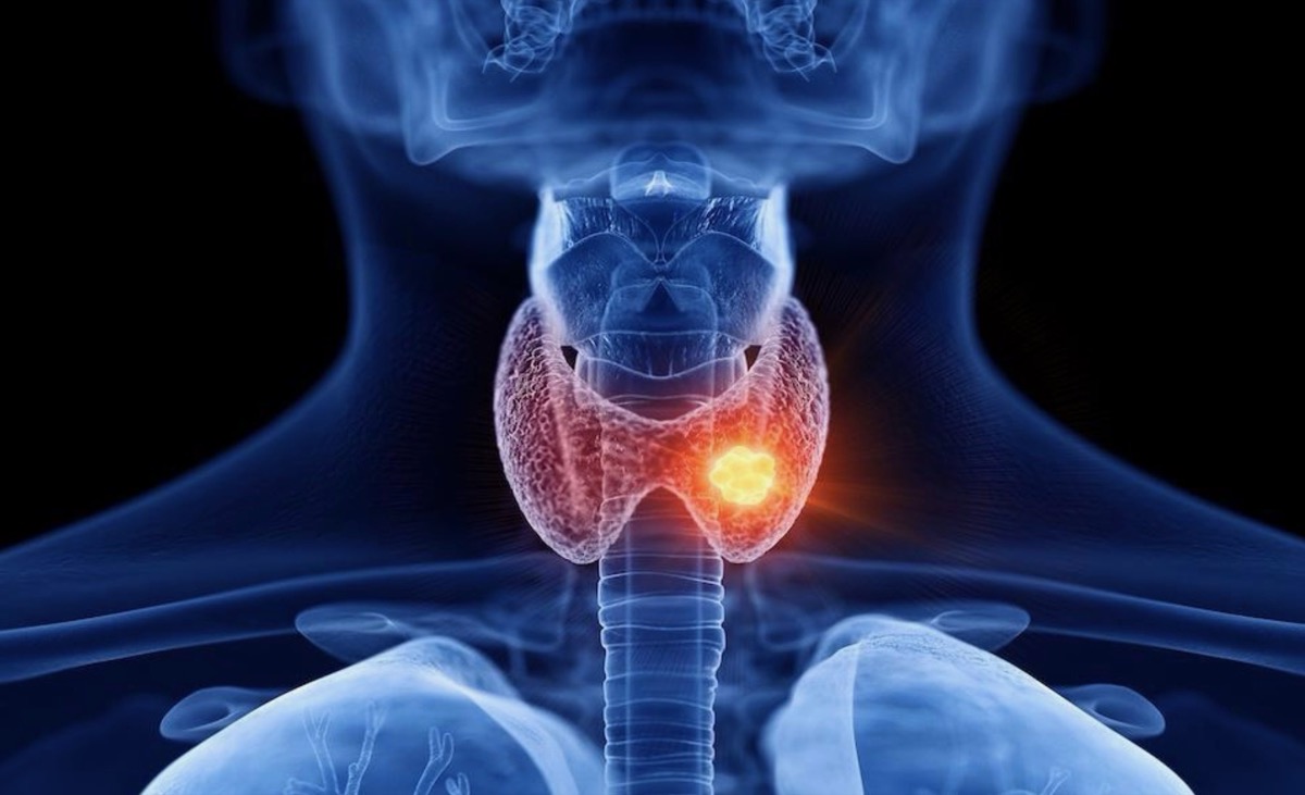3D illustration of thyroid nodule